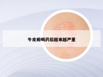 牛皮癣喝药后越来越严重