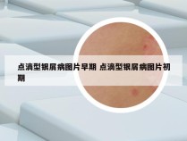 点滴型银屑病图片早期 点滴型银屑病图片初期