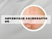 头部牛皮癣卡泊三醇 卡泊三醇软膏治疗牛皮好吗