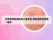 寻常型银屑病皮损上面有包 银屑病皮损周围一圈白