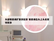 头部银屑病扩散到后背 银屑病在头上头皮屑特别多