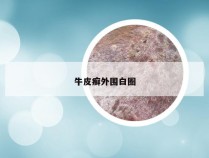 牛皮癣外围白圈