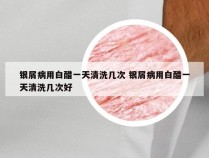 银屑病用白醋一天清洗几次 银屑病用白醋一天清洗几次好