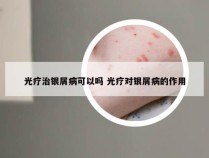 光疗治银屑病可以吗 光疗对银屑病的作用