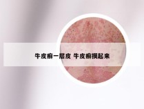 牛皮癣一层皮 牛皮癣摸起来