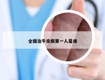 全国治牛皮癣第一人是谁