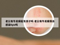 老公有牛皮癣能生孩子吗 老公有牛皮廨我会感染hpv吗