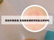 贵阳市银屑病 贵阳银屑病研究院能治得好吗