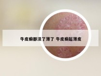 牛皮癣都淡了薄了 牛皮癣起薄皮