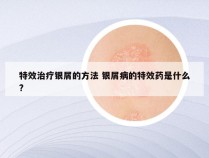 特效治疗银屑的方法 银屑病的特效药是什么?