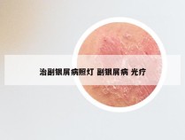 治副银屑病照灯 副银屑病 光疗