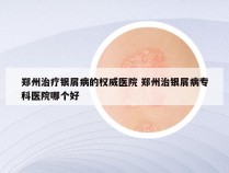 郑州治疗银屑病的权威医院 郑州治银屑病专科医院哪个好