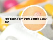 寻常银屑怎么治疗 寻常银屑病是什么原因引起的