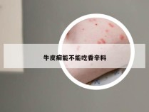 牛皮癣能不能吃香辛料