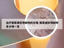 治疗银屑病生物制剂的价格 银屑病生物制剂多少钱一支