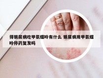 得银屑病吃甲氨蝶呤有什么 银屑病用甲氨蝶呤停药复发吗