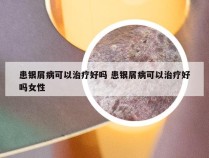 患银屑病可以治疗好吗 患银屑病可以治疗好吗女性