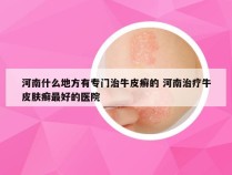 河南什么地方有专门治牛皮癣的 河南治疗牛皮肤癣最好的医院