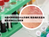 白醋对银屑病有什么作用吗 银屑病的克星白醋皮肤病怎么治皮屑