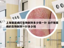 上海银屑病打生物制剂多少钱一针 治疗银屑病的生物制剂一针多少钱