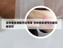 吉林银屑病医院在哪里 吉林银屑病专科医院哪家好