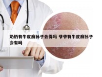 奶奶有牛皮癣孙子会得吗 爷爷有牛皮癣孙子会有吗