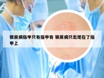 银屑病指甲只有指甲有 银屑病只出现在了指甲上