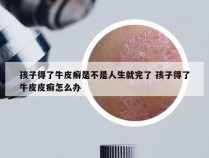 孩子得了牛皮癣是不是人生就完了 孩子得了牛皮皮癣怎么办