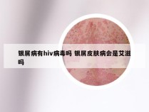 银屑病有hiv病毒吗 银屑皮肤病会是艾滋吗