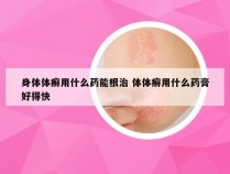 身体体癣用什么药能根治 体体癣用什么药膏好得快