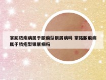 掌跖脓疱病属于脓疱型银屑病吗 掌跖脓疱病属于脓疱型银屑病吗