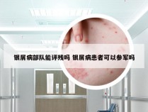 银屑病部队能评残吗 银屑病患者可以参军吗