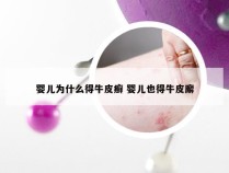 婴儿为什么得牛皮癣 婴儿也得牛皮廨