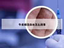 牛皮癣流白水怎么回事