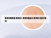 银屑病颜色变暗红 银屑病由红变暗红是好是坏