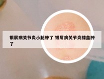 银屑病关节炎小腿肿了 银屑病关节炎膝盖肿了