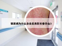 银屑病为什么会自愈表彰长春华山3