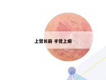 上臂长藓 手臂上癣
