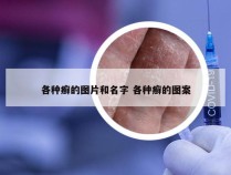 各种癣的图片和名字 各种癣的图案