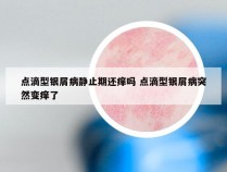 点滴型银屑病静止期还痒吗 点滴型银屑病突然变痒了