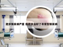 跑步银屑病严重 我跑步治好了寻常型银屑病