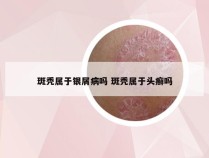 斑秃属于银屑病吗 斑秃属于头癣吗