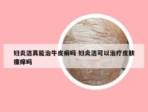 妇炎洁真能治牛皮癣吗 妇炎洁可以治疗皮肤瘙痒吗
