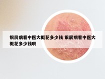 银屑病看中医大概花多少钱 银屑病看中医大概花多少钱啊