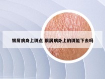 银屑病身上斑点 银屑病身上的斑能下去吗