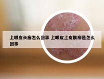 上眼皮长癣怎么回事 上眼皮上皮肤癣是怎么回事
