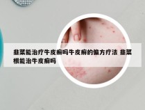 韭菜能治疗牛皮癣吗牛皮癣的偏方疗法 韭菜根能治牛皮癣吗