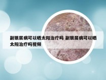 副银屑病可以晒太阳治疗吗 副银屑病可以晒太阳治疗吗视频