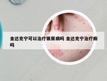 金达克宁可以治疗银屑病吗 金达克宁治疗癣吗