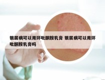 银屑病可以用环吡酮胺乳膏 银屑病可以用环吡酮胺乳膏吗